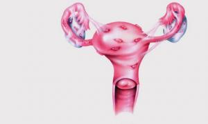 Mga palatandaan ng endometriosis ng pusod at paggamot nito