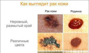 Rakovina kože: typy, príznaky a liečba