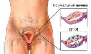 Поликистоз: шансы забеременеть Беременность при поликистозе яичников без лечения
