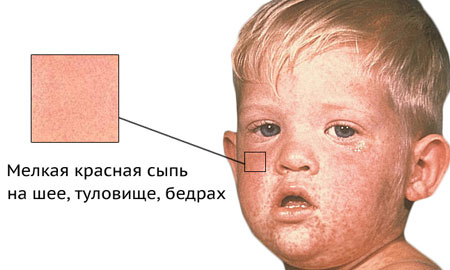 Инфекциозни и неинфекциозни кожни заболявания при деца: симптоми, описание Кожни инфекции при деца