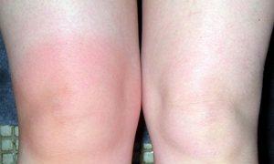 Дегенеративни промени в менискусите на колянната става