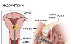 Biopsija endometrija (maternice): indikacije, metode in izvedba, rezultati