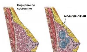 Lahat tungkol sa mastitis: sintomas, sanhi, paraan ng paggamot Mastitis mastitis sintomas