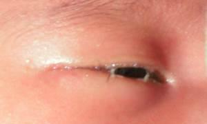 Otrok se pritožuje zaradi bolečine v očeh