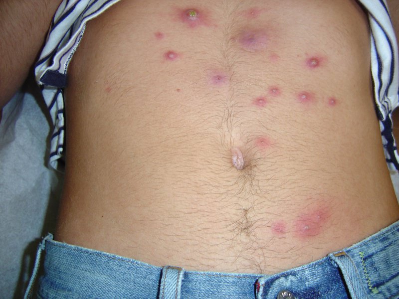 Furunculosis - sanhi at paggamot, larawan, nakakahawang, lalo na sa mga bata Ano ang dapat gawin sa unang tanda ng isang pigsa