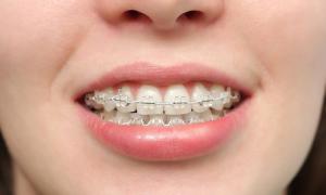 Kaj zdravi zobozdravnik ortodont?