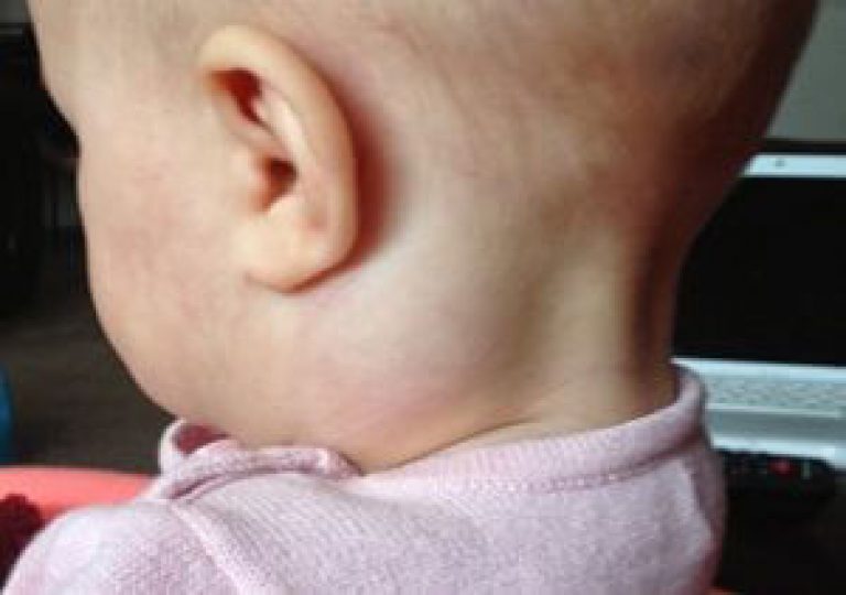 Zväčšené lymfatické uzliny v krku dieťaťa: príčiny, príznaky, metódy liečby