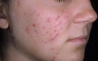 Secrets of getting rid of acne at home How to get rid of acne at home