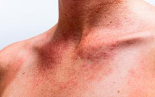 Аллергия на солнце: причины, симптомы, лечение