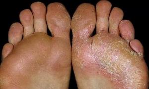 Symptoms and treatment of skin fungus on the legs