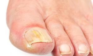 Treatment and symptoms of fungus on the feet