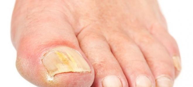 Лечение и симптоми на гъбички по краката