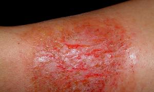 Alergia na slnko - typy, príznaky a liečba