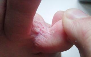 Znaki, simptomi in zdravljenje glivic na nogah med prsti